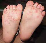 Hand, foot and mouth disease