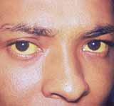 Hepatitis A