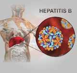 Hepatitis B