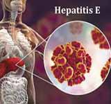 Hepatitis E