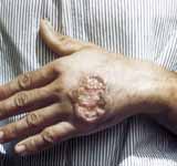 Leishmaniasis
