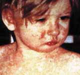 Measles