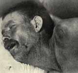 Meningitis
