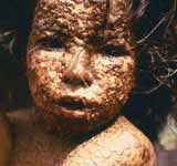 Smallpox