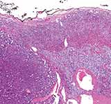 Adrenocortical Carcinoma (A form of cancer)