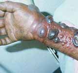 Marburg Virus